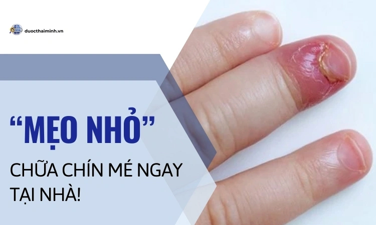 mẹo chữa chín mé