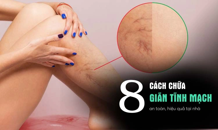 8 cách tự nhiên chữa giãn tĩnh mạch