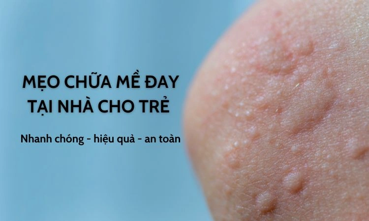 Chữa mề đay tại nhà bằng mẹo dân gian mang đến độ lành tính cao 