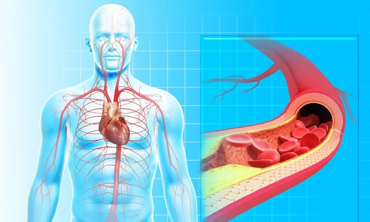 Nattokinase giúp ngăn ngừa tình trạng xơ vỡ động mạch