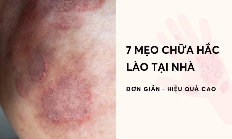 mẹo chữa hắc lào tại nhà