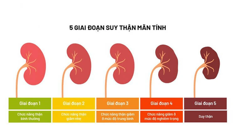 Bệnh suy thận mạn được chia thành 5 giai đoạn dựa trên mức độ lọc cầu thận (GFR).